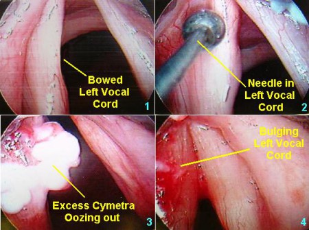 vocal cord surgery deeper voice vocal cord surgery deeper voice