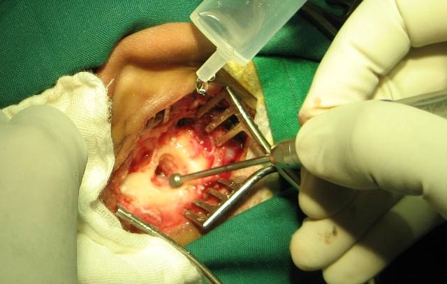 Mastoid Surgery – Dr.Gauri Belsare